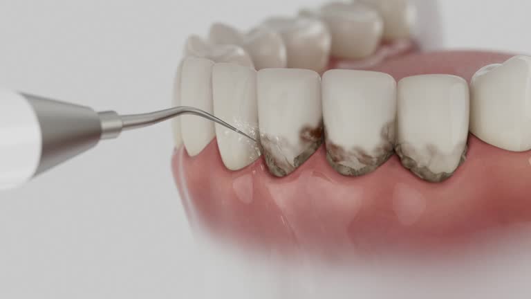 Reliable Dental Implants contractor in Belle Glade, FL by Smile Center Dentistry